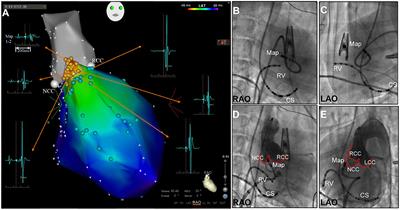 Experimental Findings and Clinical-Pathologic Correlation of Radiofrequency Catheter Ablation at the Left Ventricle Para-Hisian Region